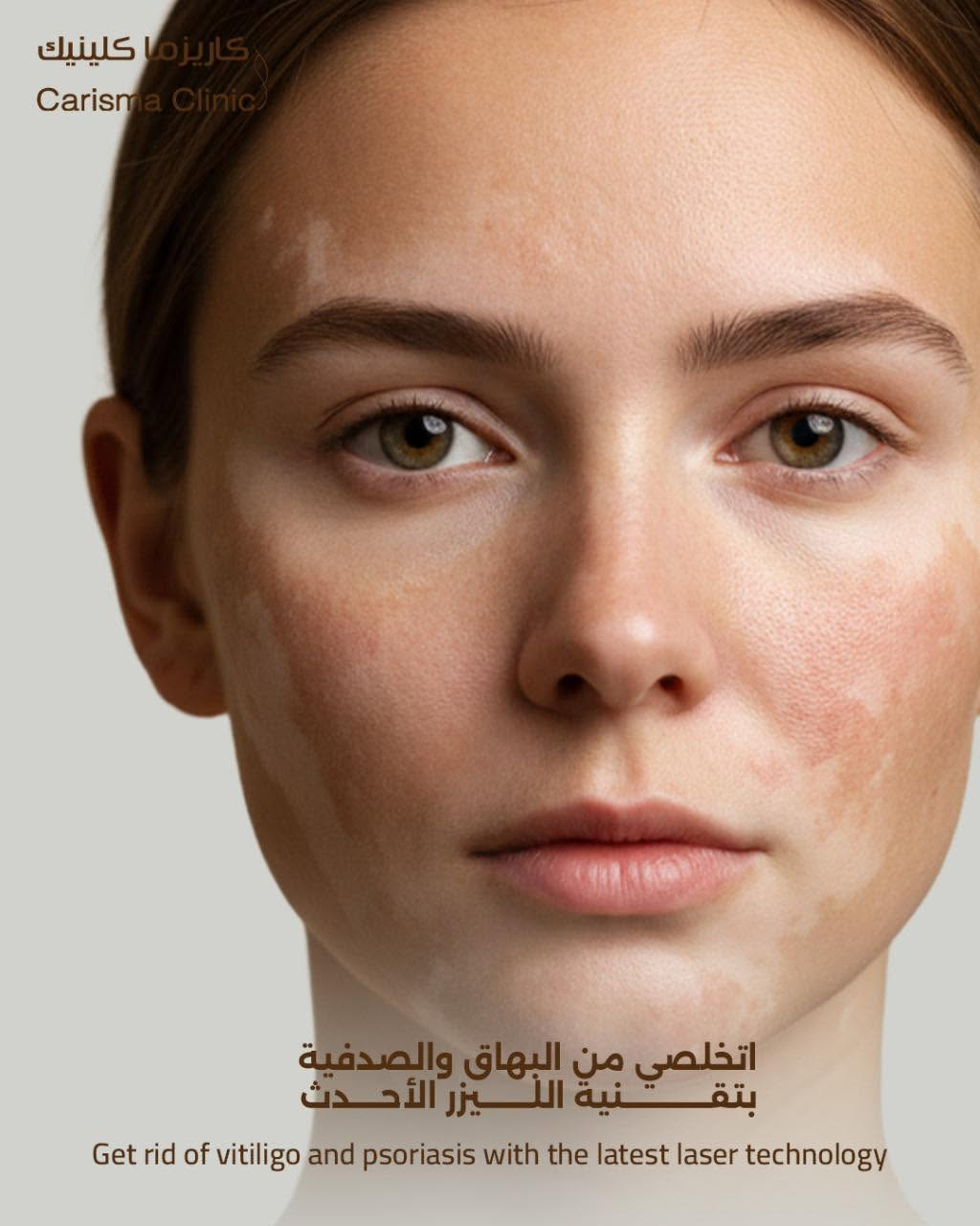 Excimer Laser Treatment for Vitiligo