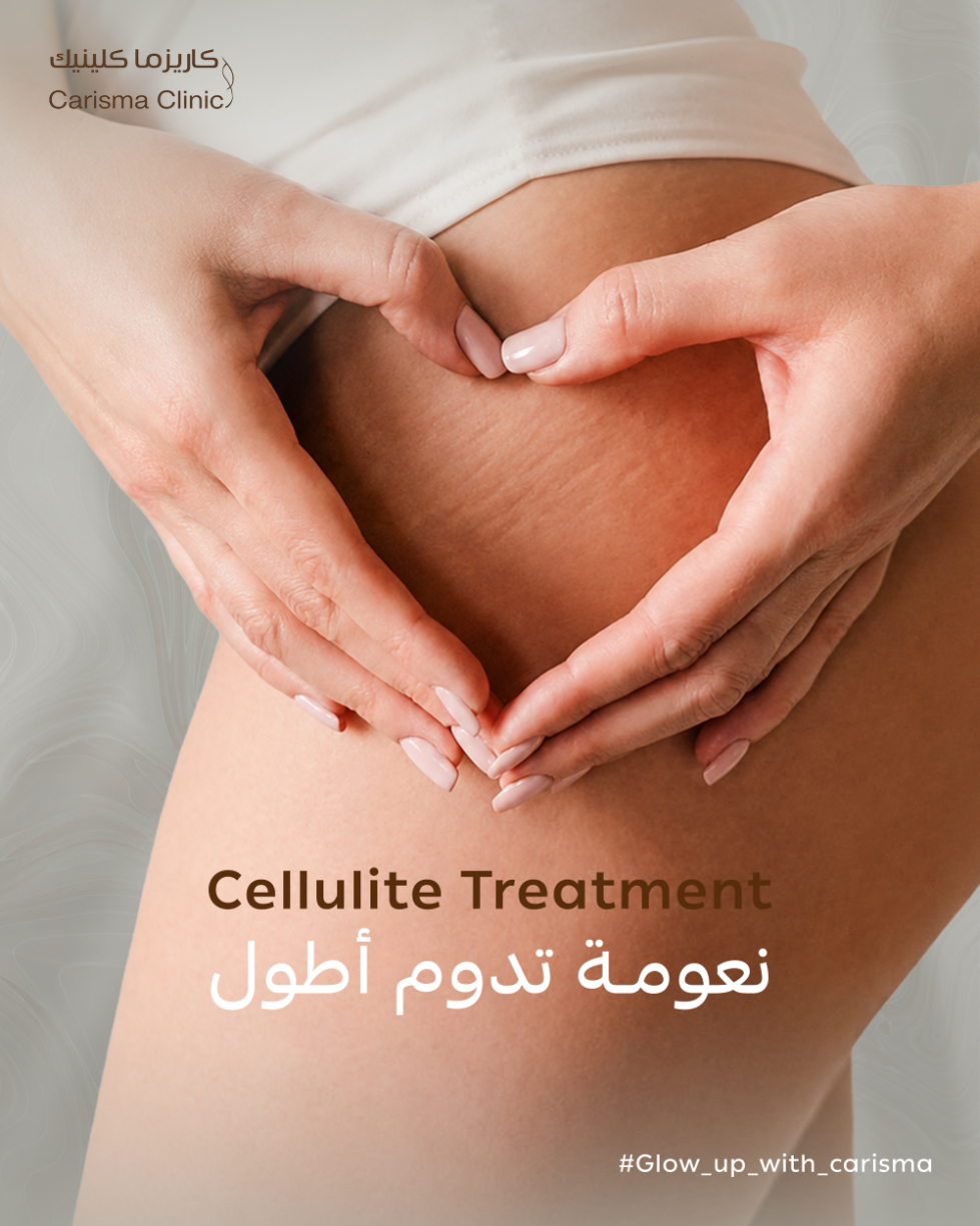 Stretch Mark Treatment
